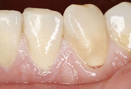 Miệng đau và nhạt màu nếu bạn đang thiếu máu, kể cả lưỡi có thể trở nên sưng phồng và mịn (viêm lưỡi).