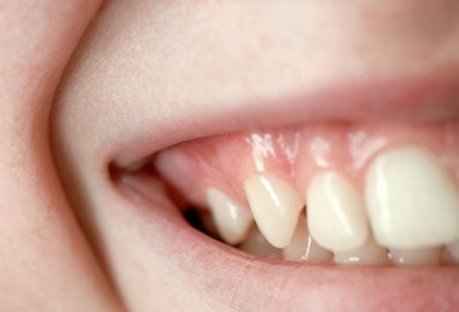 Nướu răng khỏe mạnh có màu hồng và vững chắc, không phải màu đỏ và sưng to.