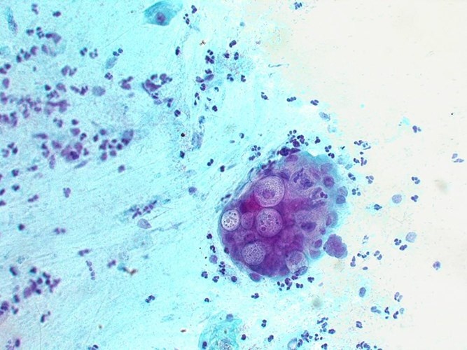 Chlamydia trachomatis. C. trachomatis là một loại vi khuẩn nội bào với nhiều serotype. C.trachomatis là một vi khuẩn gây STI phổ biến. Các biến chứng ở phụ nữ bao gồm nhiễm trùng đường tiểu, bệnh viêm vùng chậu, thai ngoài tử cung và vô sinh. Chlamydia có liên quan với tăng nguy cơ lây nhiễm HIV.