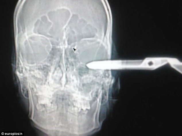 Chiếc kéo đâm vào sâu vào đỉnh thùy não và thật may mắn là anh này đã sống sót.  Các nhân chứng kể lại rằng khi Jonas đang ngồi cùng bạn trong quán bar thì bất ngờ bị một người đàn ông đến gây sự và tấn công. Tuy rất đau đớn nhưng anh vẫn bình tĩnh lên xe và cùng bạn đến bệnh viện. Các nhân viên ở đây đặt biệt danh cho Jonas là