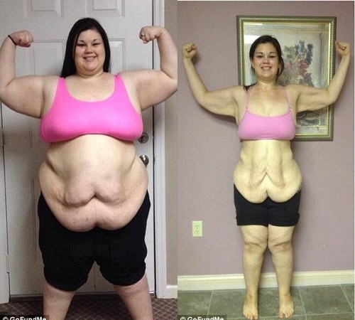 Phai phau thuat cat da thua vi giam can gan 100 kg hinh anh