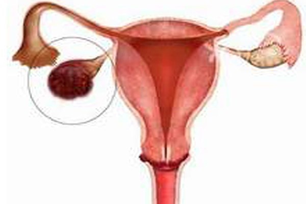 Giới nghiên cứu ước tính rằng, khoảng 59% các trường hợp ung thư này có thể ngăn chặn nếu phụ nữ vận động ít nhất 30 phút mỗi ngày để tránh để cơ thể thừa mỡ. Con số được đong trên 29.500 trường hợp ung thư mỗi năm tại Mỹ.