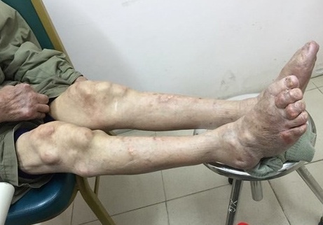 Suy than vi dieu tri gout o phong kham dong y Trung Quoc hinh anh