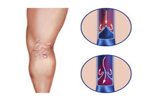 Bệnh suy tĩnh mạch. Di truyền là yếu tố chính liên quan đến căn bệnh này, nhưng nếu trọng lượng quá khổ ở vùng mông hông sẽ tạo áp lực lên các tĩnh mạch. Hơn nữa, trọng lượng dư thừa cũng làm cho đầu gối và khớp xương bị bào mòn nhanh hơn do ghánh nặng phần trên đè xuống.