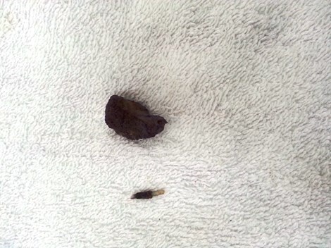 Viên sỏi và nhánh vòng chữ T,