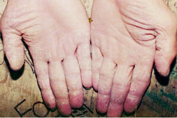 Da tay bị đóng vảy. Gặp ngay bác sỹ da liễu nếu tay bong vảy đỏ, vì nó có thể là dấu hiệu của bệnh ung thư do dày sừng actinic. Cũng có thể là bạn mắc bệnh vẩy nến, là một bệnh ngoài da kinh niên, tạo những về đỏ, dày trên da với những vẩy trắng, trông giống những vẩy nến. Trường hợp nhẹ có thể dùng kem bôi, nặng thì cần chiếu đèn hoặc uống thuốc.