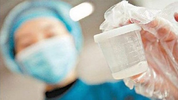 Người mắc tinh dịch vón cục là khi nam giới xuất tinh, tinh dịch là những hạt trắng nhỏ như hạt cơm, bóp thấy mịn như bột.