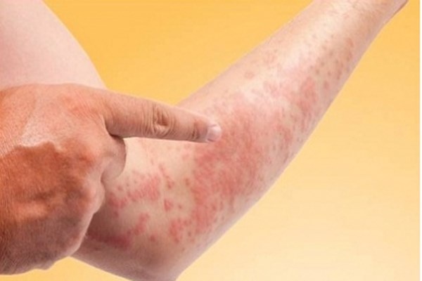 5. Dị ứng. Hệ thống miễn dịch sẽ cố gắng xả hết chất độc ra khỏi máu, do đó da sẽ nổi dị ứng mẩn đỏ. Nếu bạn cố gãi thì sẽ thành vết loét, vi khuẩn bên ngoài có cơ hội hợp tác chiến đấu với vi khuẩn trong máu và nếu bạn dùng thuốc chống dị ứng, vô tình vi khuẩn “được” ở lại cơ thể dẫn đến bước thứ 6.
