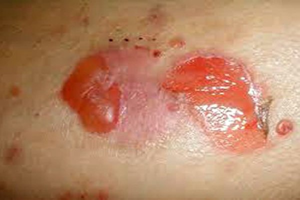 7. Loét. Cơ thể chúng ta rất tỉnh táo và khôn ngoan, các vùng viêm loét sẽ ức chế vi khuẩn đi khắp mọi nơi. Khi nguyên liệu không đủ phục vụ việc cưỡng chế vi khuẩn lan ra thì cơ thể lâm vào tình trạng thứ 8.