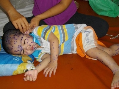 Khi các phỏng thủy đậu vỡ, không nên bôi thuốc mỡ mà nên bôi thuốc xanh methyle.