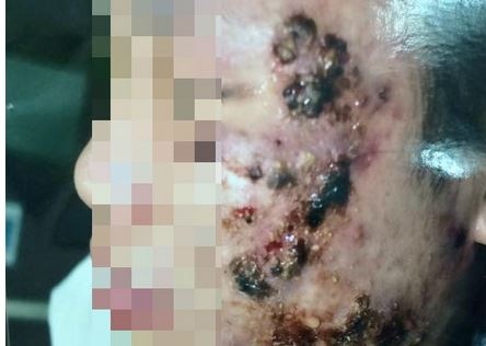 Soc voi mat noi mun chi chit vi lam dung kem trang da hinh anh