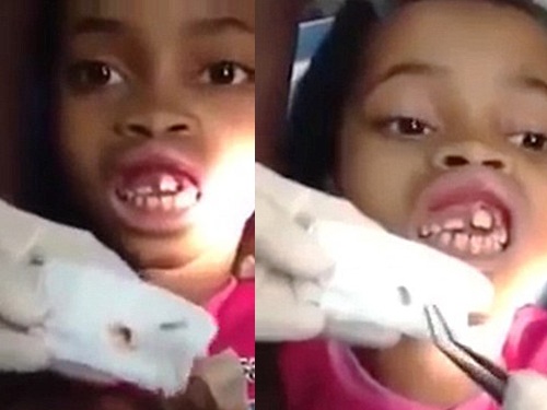 Gap 15 con doi ra khoi mieng be gai hinh anh