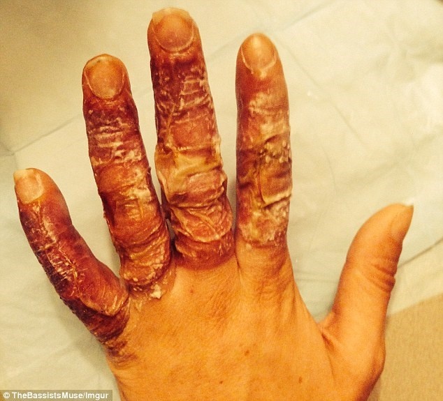 Bàn tay sau khi những vết phồng vị bỡ.