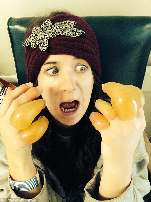 Bàn tay sưng to, phồng rộp của Emma Quirk.