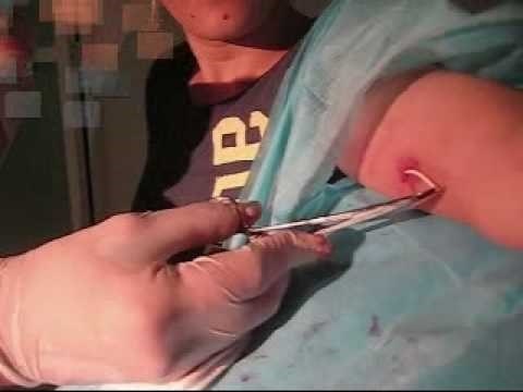 3. Sau khi rút que cấy, sự thụ thai hồi phục nhanh chóng và hoàn toàn. Có thể lấy que cấy bất cứ khi nào bạn muốn. Nếu bạn muốn có thai trở lại, hãy đến cơ sở y tế, nhân viên y tế sẽ lấy que cấy ra cho bạn.