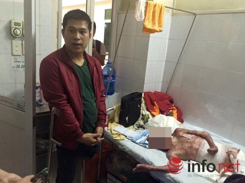 Cháu Hùng và anh Hưng đang ở khoa Nhi, viện Bỏng quốc gia.