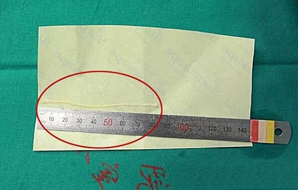 Ky sinh trung dai 8 cm 'lam to' trong nao gan 25 nam hinh anh