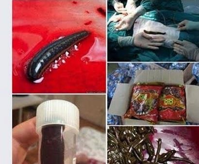 Khong co chuyen dia trong bung nguoi o Benh vien Bach Mai hinh anh