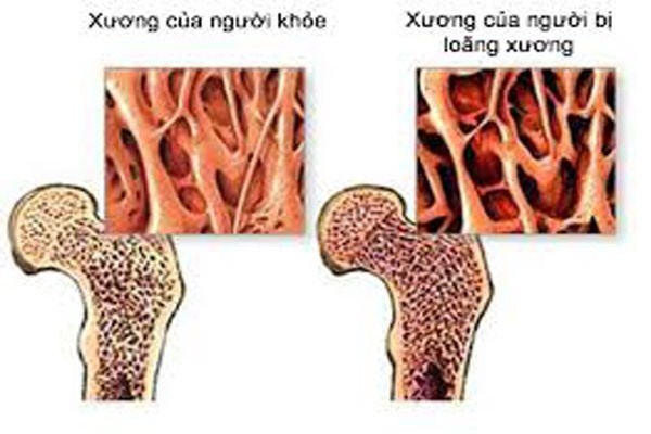 Gây loãng xương. Thường xuyên ăn no khiến hormone ở tuyến giáp trạng tăng cao, làm các phân tử can-xi suy giảm, nhẹ thì loãng xương, nặng thì xốp xương, thậm chí gây gãy xương.