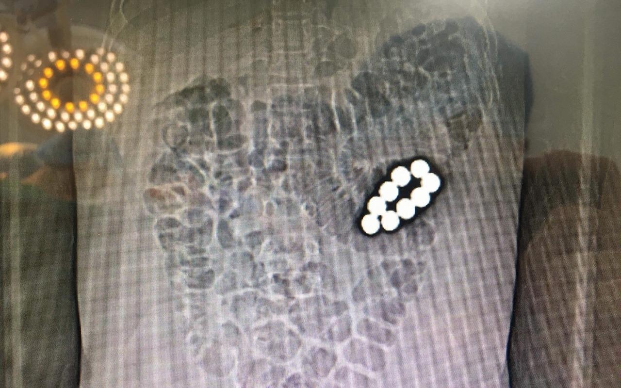 Nam sinh nghi bi ep nuot 9 vien bi sat, nha truong noi gi? hinh anh