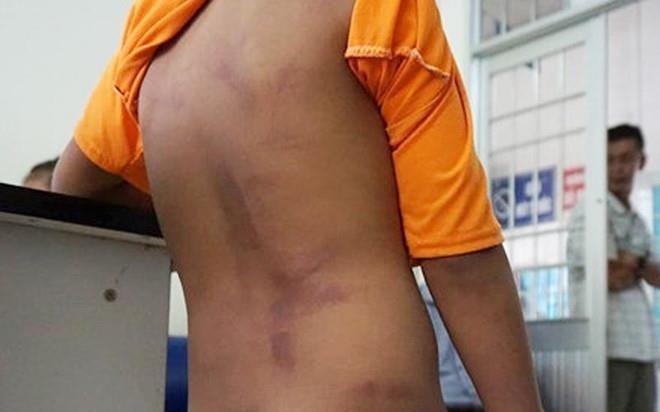 4 hoc sinh bi danh 250 roi, xat muoi ot vao vet thuong chua the di hoc hinh anh