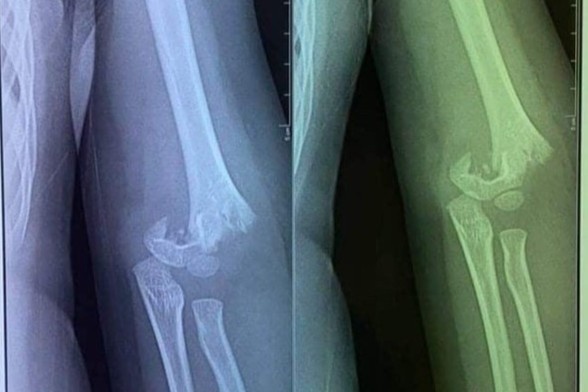 So GD&DT Ha Noi yeu cau xac minh vu tre mam non bi gay tay o truong hinh anh