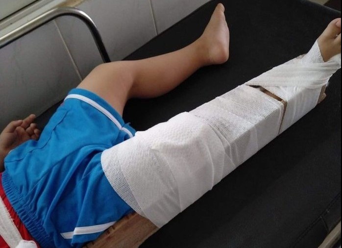 Co giao bi dinh chi day hoc vi lam gay chan tre 3 tuoi hinh anh