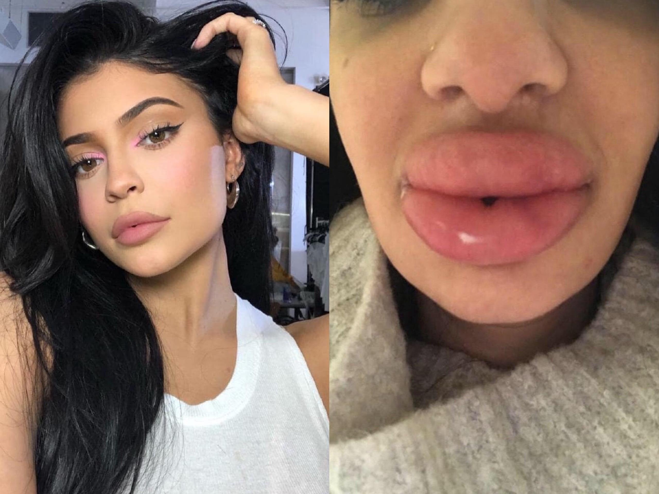 Co gai bi sung phong, cung do moi vi tiem filler giong Kylie Jenner hinh anh