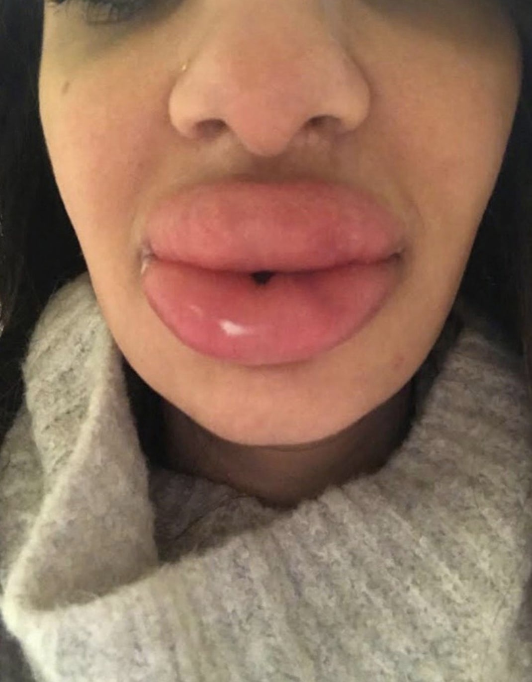 sưng môi do tiêm filler ảnh 2 sung moi do tiem filler anh 2