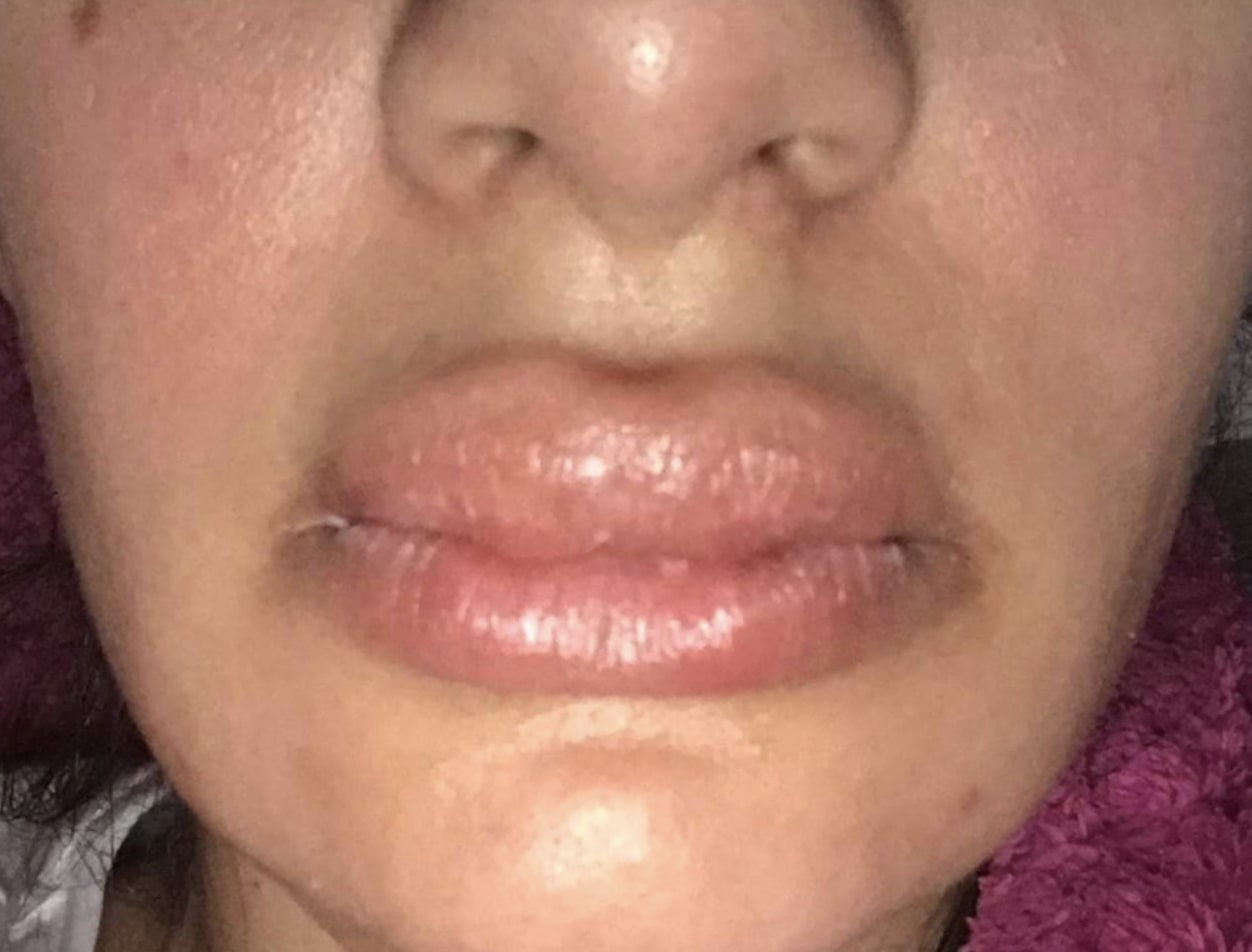 sưng môi do tiêm filler ảnh 3 sung moi do tiem filler anh 3
