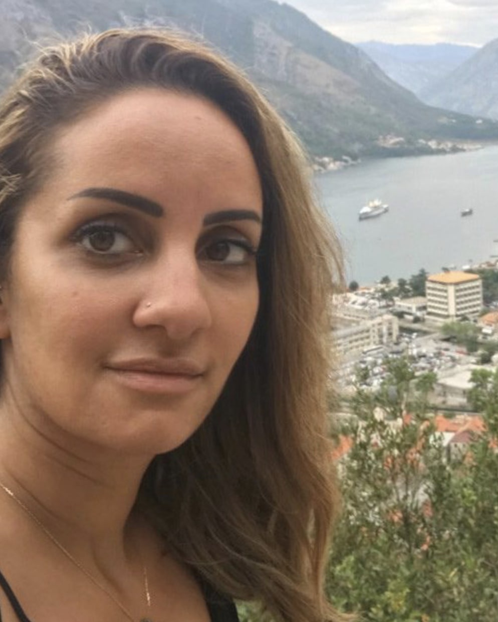 sưng môi do tiêm filler ảnh 1 sung moi do tiem filler anh 1