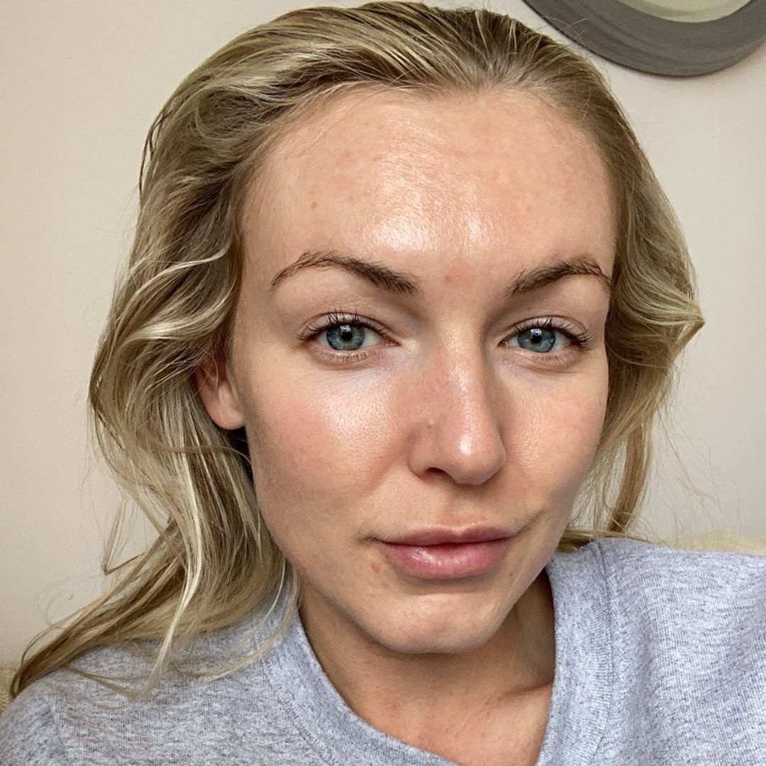 hành trình trị mụn trứng cá của Ella Gorton ảnh 3 hanh trinh tri mun trung ca cua Ella Gorton anh 3