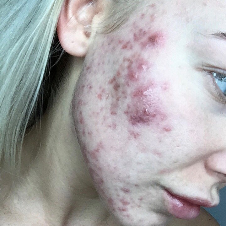 hành trình trị mụn trứng cá của Ella Gorton ảnh 2 hanh trinh tri mun trung ca cua Ella Gorton anh 2