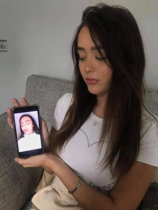 xưng môi vì tiêm chất làm đầy ảnh 3 xung moi vi tiem chat lam day anh 3