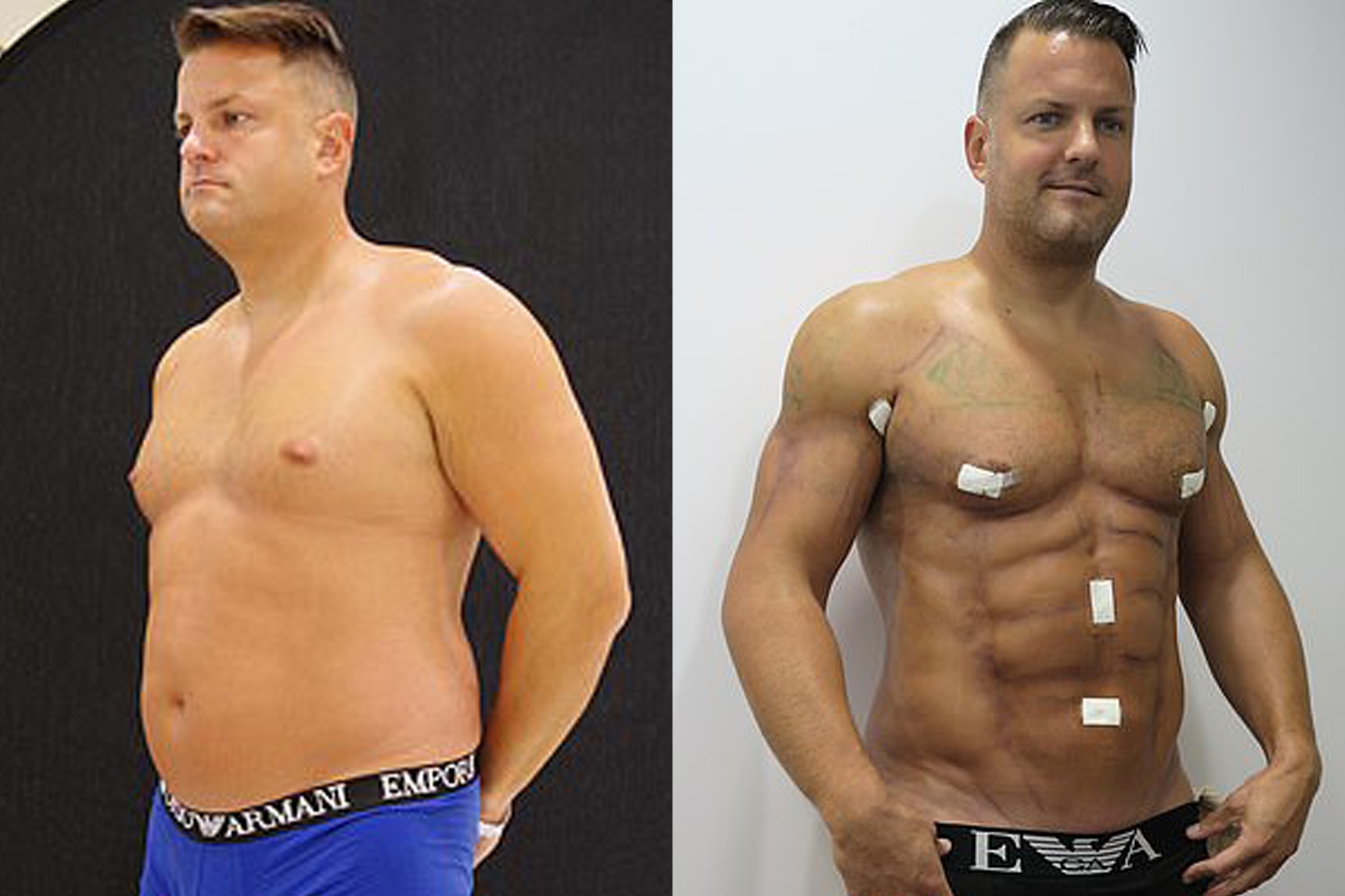 Ong bo chi 19.000 USD hut mo bung de co than hinh 6 mui hinh anh