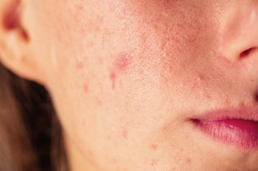 10 thuc pham khien da bi mun hinh anh