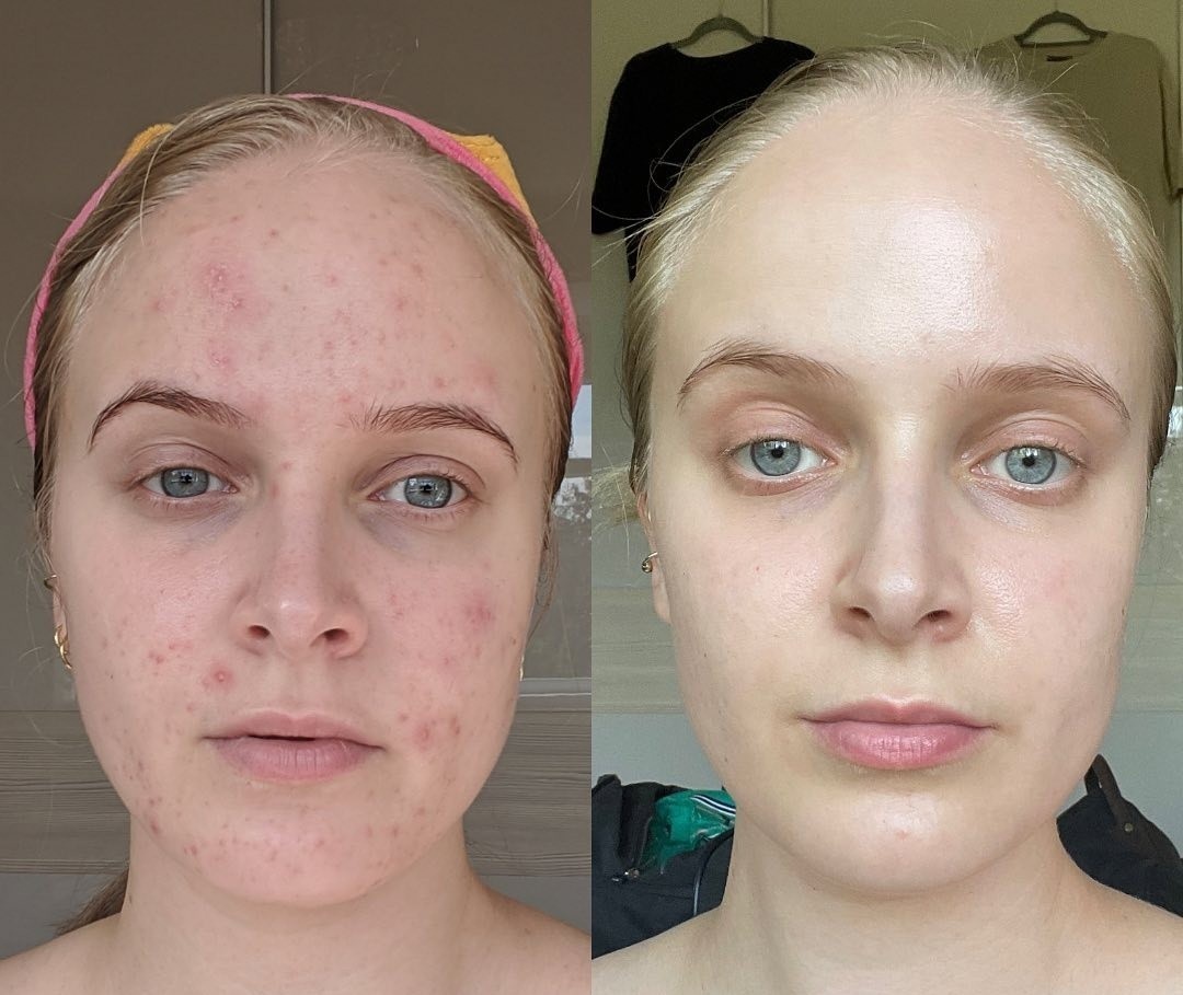 len mun vi dung thuoc tranh thai anh 1