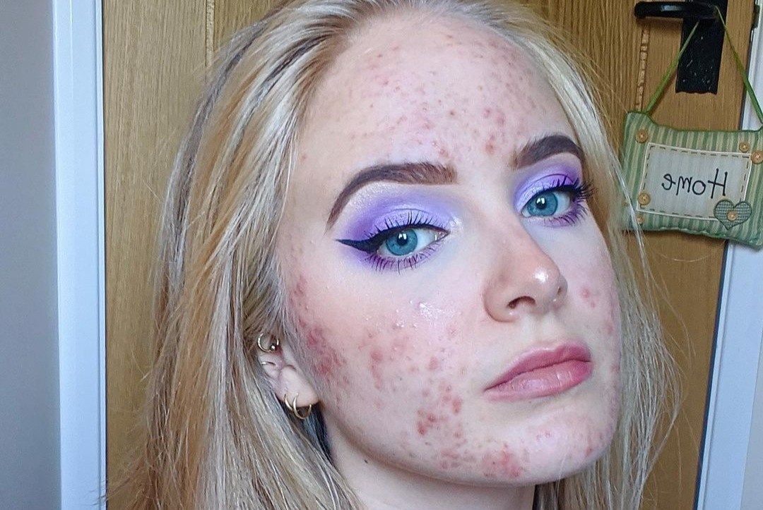 Len mun day mat vi dung thuoc tranh thai hinh anh