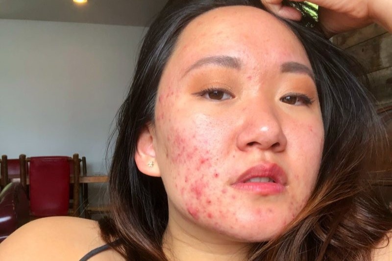 Tam su cua co gai bi mun tu nam 12 tuoi hinh anh