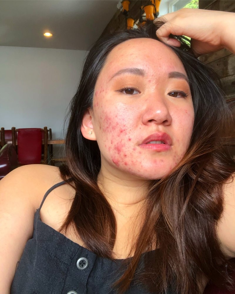 Cô gái bị mọc mụn từ năm 12 tuổi ảnh 4 Co gai bi moc mun tu nam 12 tuoi anh 4