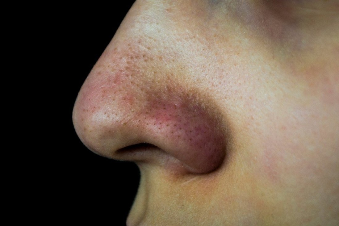 Cach tri mun dau den anh 1