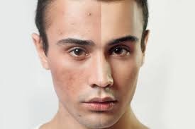 Thoi quen giup nam gioi ngan ngua mun hinh anh