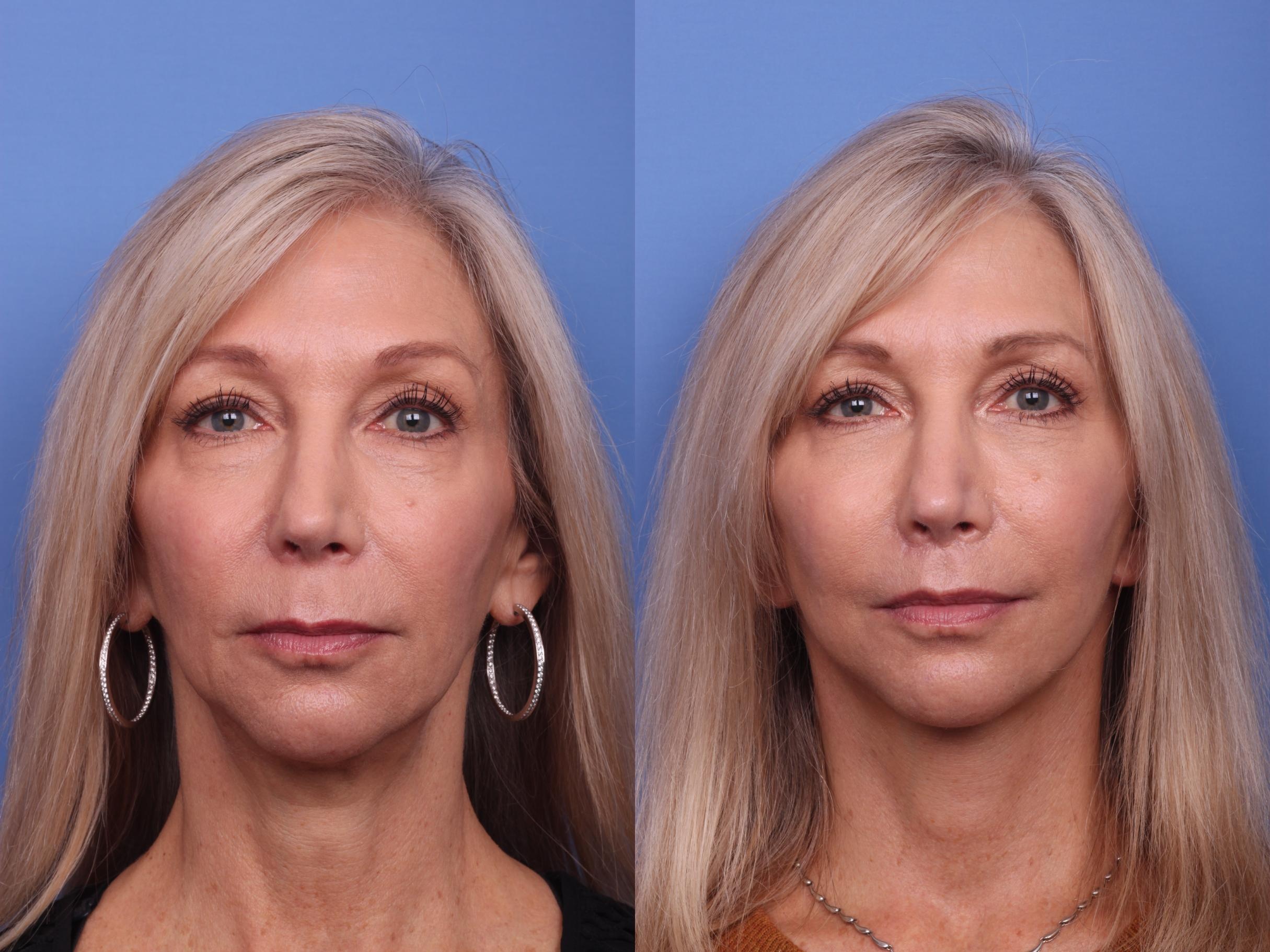 Ca nang co mat tri gia 200.000 USD anh 1