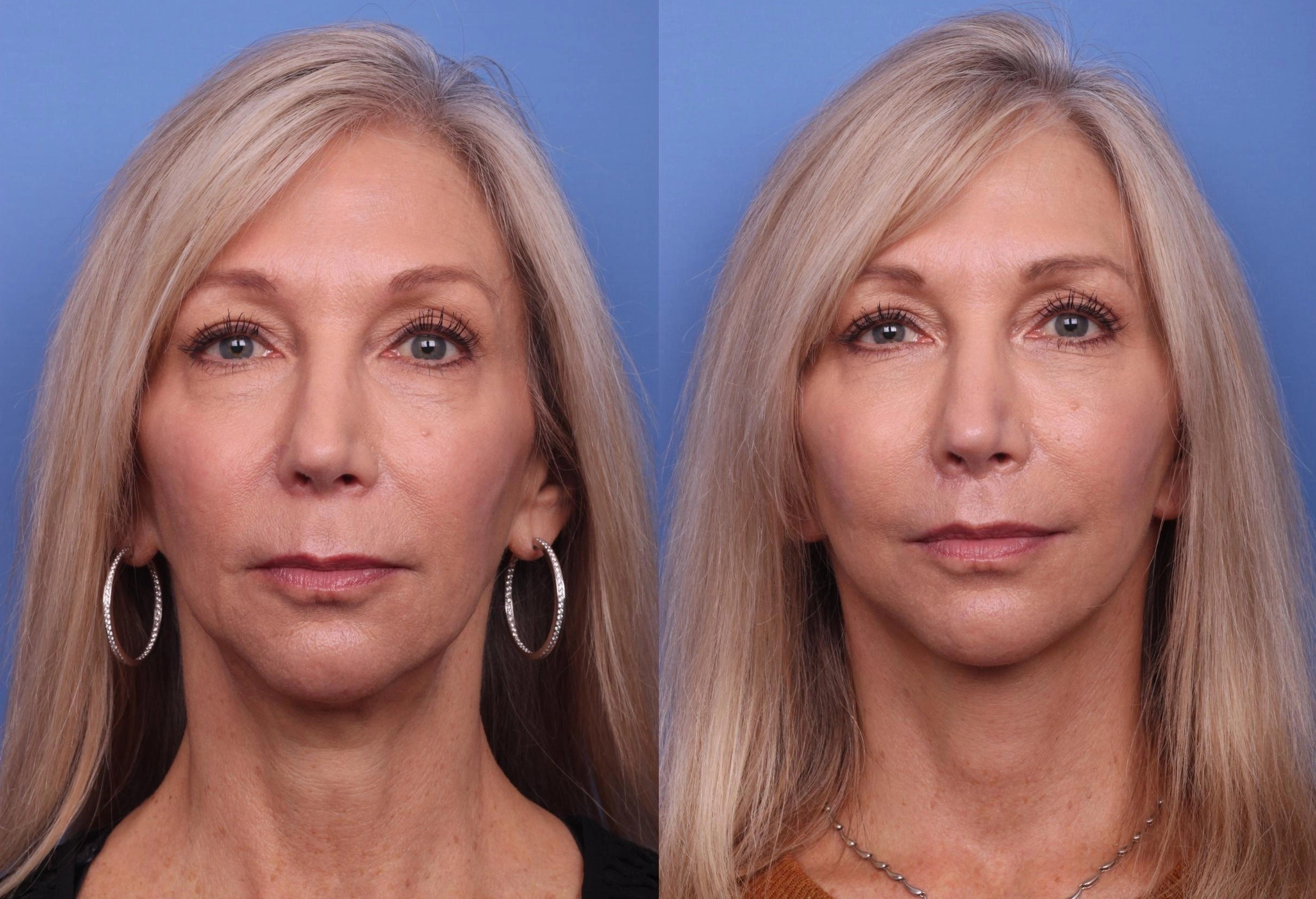 Ca nang co mat gia 200.000 USD hinh anh