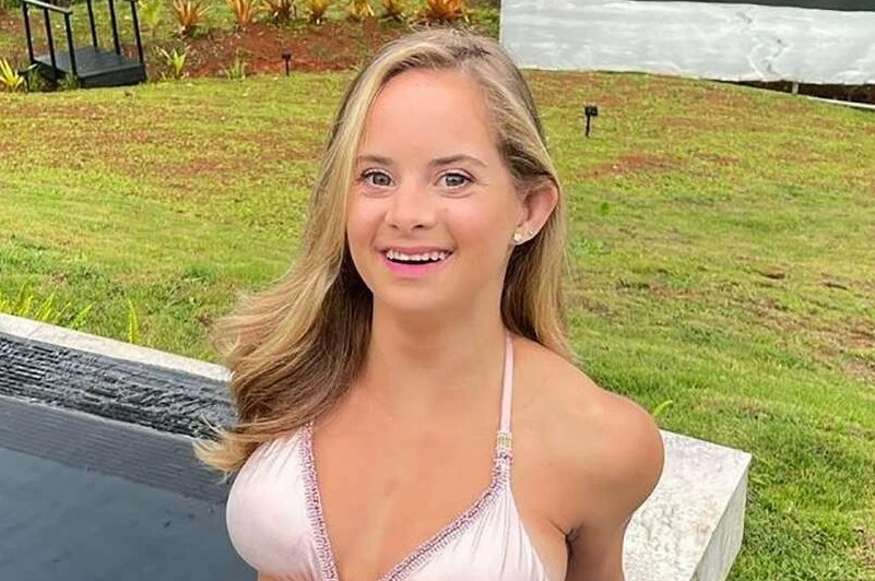 Nguoi mau noi y mac hoi chung Down hinh anh