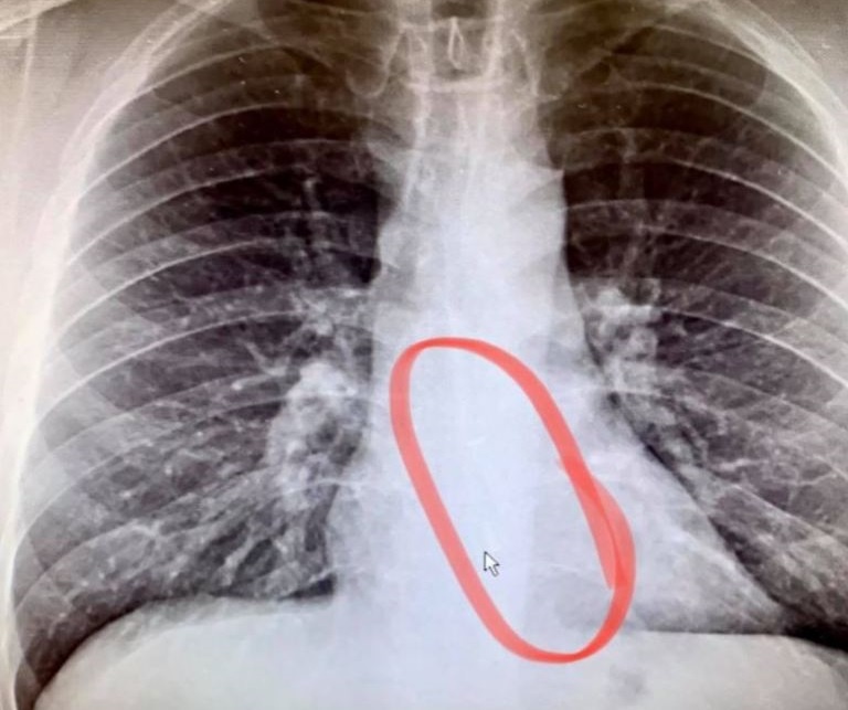 Nuot AirPods vao bung trong khi ngu anh 1