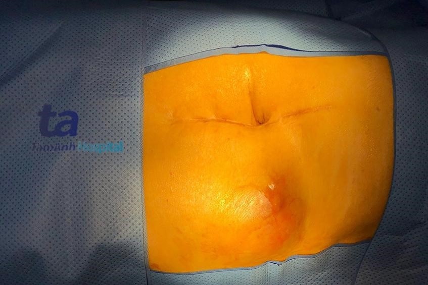 u nang,  thoat vi,  Tam Anh,  BVDK Tam Anh anh 1