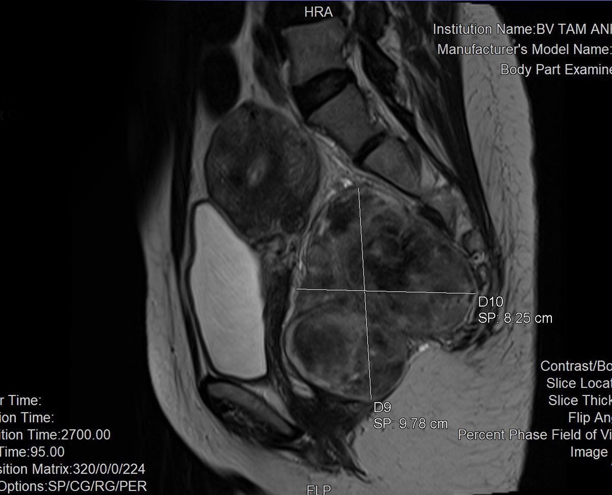 noi soi,  phau thuat noi soi,  khoi u,  robot co hoc,  benh vien Tam Anh anh 1