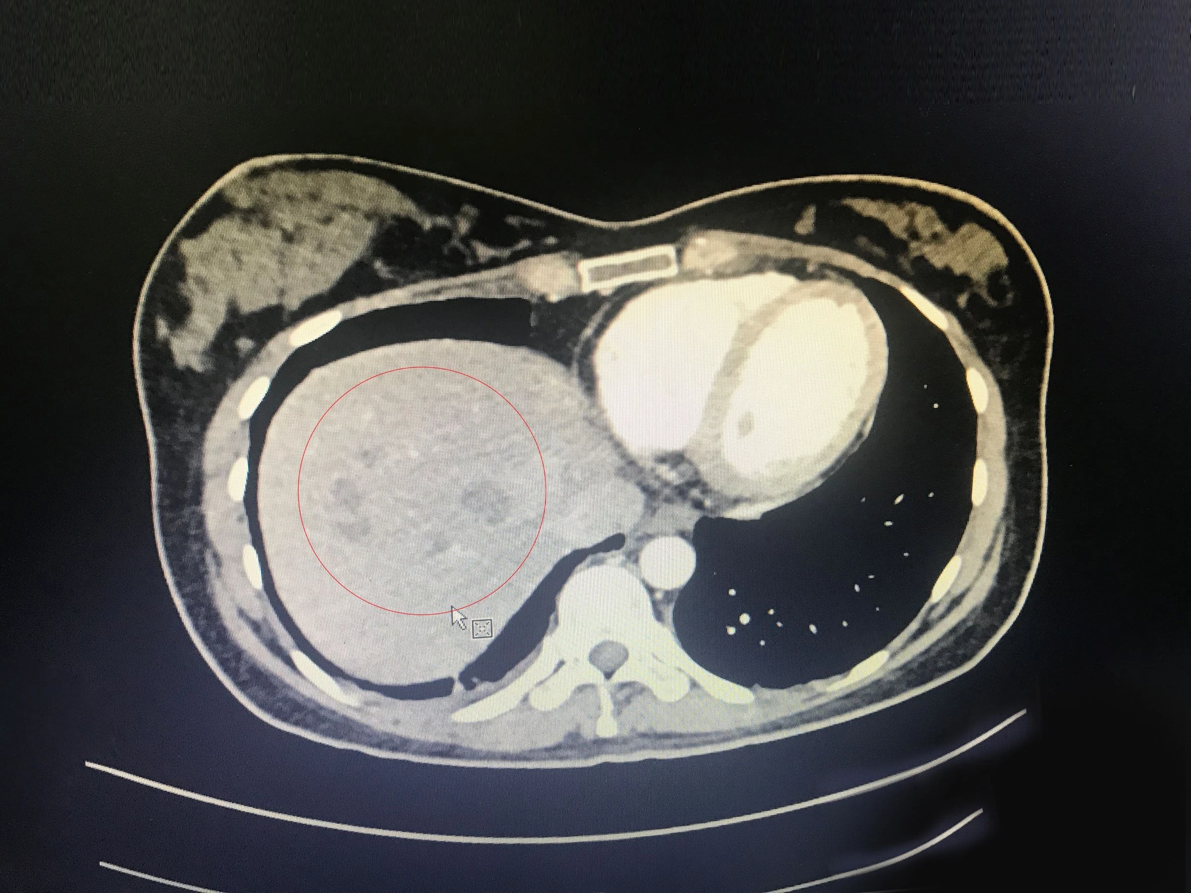 Dau bung tuong hau Covid-19, kham thay san hinh chiec la o gan hinh anh
