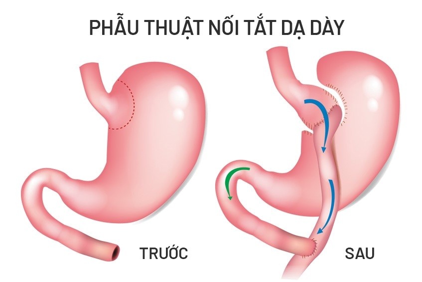béo phì,  phẫu thuật giảm cân,  BVĐK Tâm Anh ảnh 1 beo phi,  phau thuat giam can,  BVDK Tam Anh anh 1
